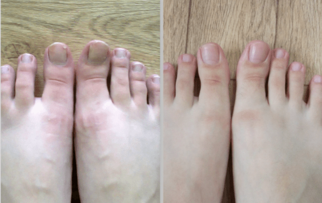 Antes y después del tratamiento para hongos en las uñas de los pies. 