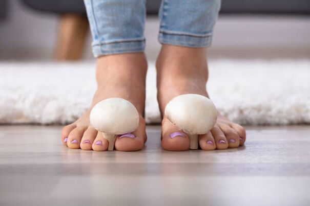 hongos en las uñas de los pies