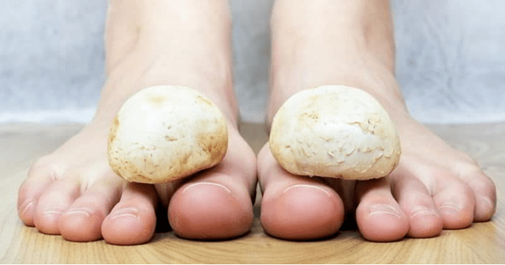 Tratamiento rápido de hongos en las piernas en casa