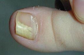 Las razones de la aparición del hongo en el pulgar de la pierna