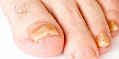 Cómo y cómo curar el hongo de las uñas