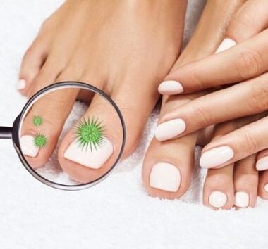 Infección de uñas a través de una lupa