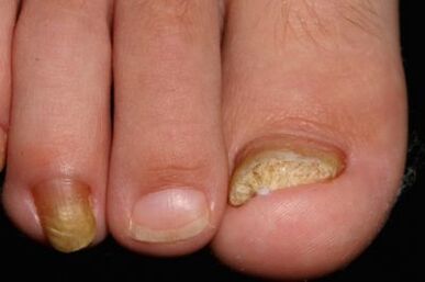 Micosis de uñas en las piernas