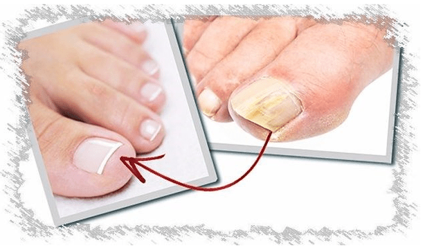 Causas de hongos de uñas