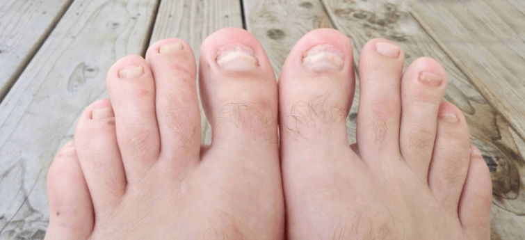 Hongo de uñas