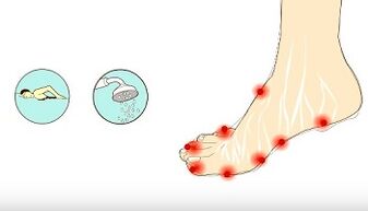 causas de hongos en los dedos de los pies