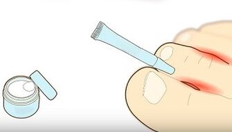 cómo tratar los hongos en los dedos de los pies