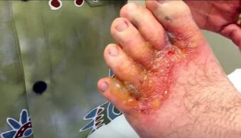 síntomas de hongos en los dedos de los pies
