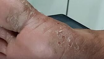 tipos y formas de hongos en los dedos de los pies