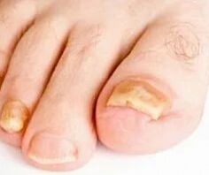 Onicomicosis