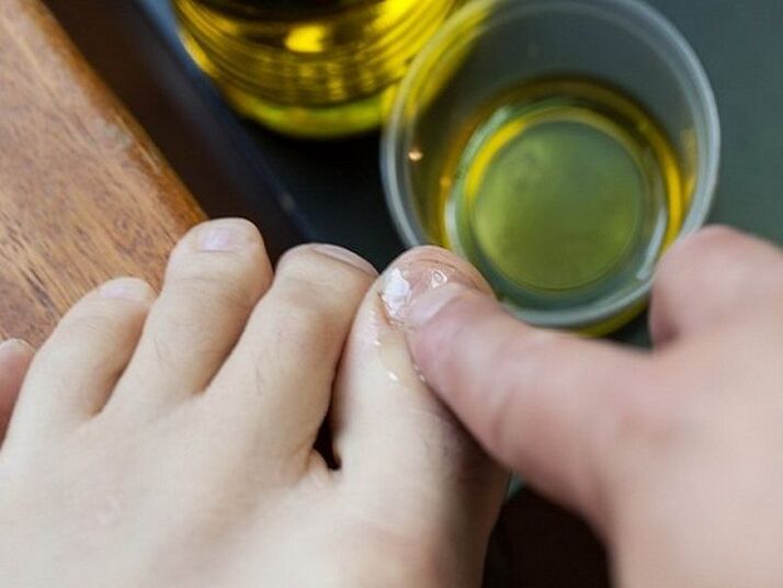 Aplicar aceite medicinal a las uñas afectadas por hongos.