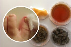 Tratamiento de hongos en las uñas de los pies con remedios caseros.