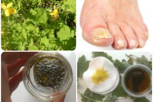 remedios caseros para los hongos en las uñas de los pies