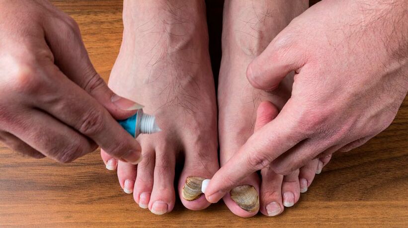 Aplicar crema antimicótica en las uñas de los pies para tratar la onicomicosis